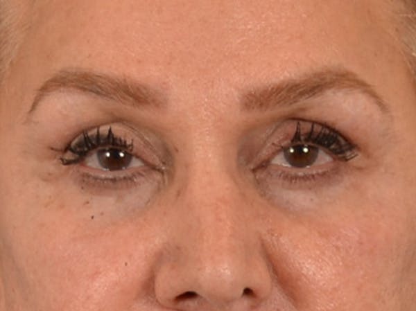 Eyelid Lift Before & After Gallery - Patient 453896 - Image 2