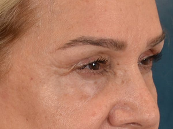 Eyelid Lift Before & After Gallery - Patient 453896 - Image 3
