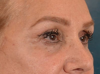 Eyelid Lift Before & After Gallery - Patient 453896 - Image 4