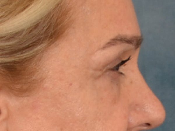 Eyelid Lift Before & After Gallery - Patient 453896 - Image 5