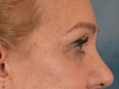 Eyelid Lift Before & After Gallery - Patient 453896 - Image 6