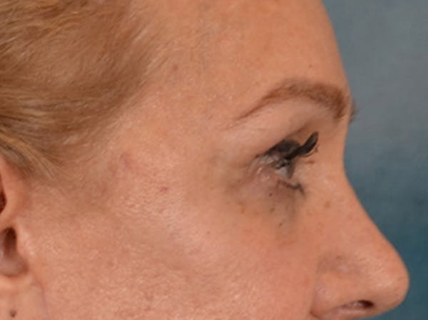 Eyelid Lift Before & After Gallery - Patient 453896 - Image 6