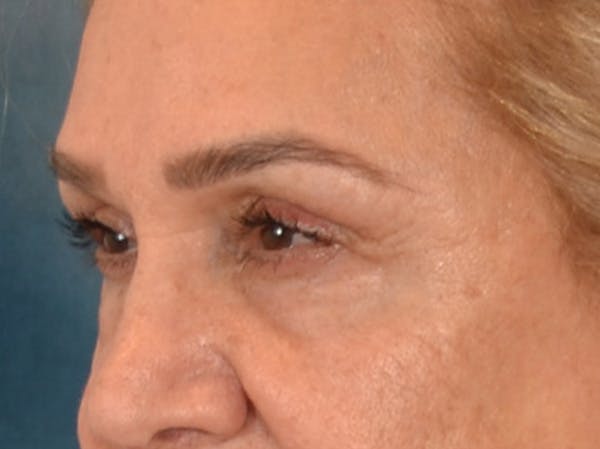 Eyelid Lift Before & After Gallery - Patient 453896 - Image 7