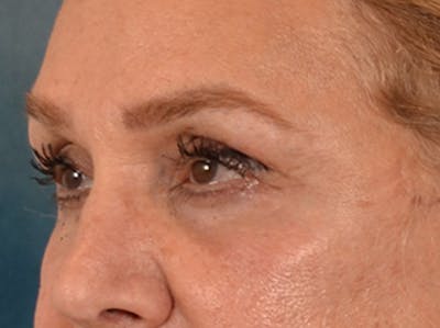 Eyelid Lift Before & After Gallery - Patient 453896 - Image 8