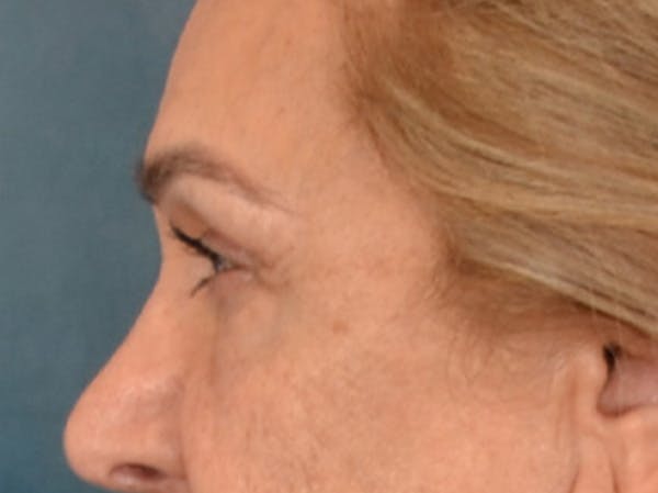 Eyelid Lift Before & After Gallery - Patient 453896 - Image 9