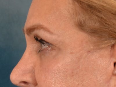 Eyelid Lift Before & After Gallery - Patient 453896 - Image 10