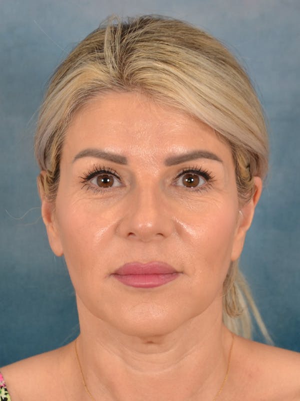 Brow Lift Before & After Gallery - Patient 208538 - Image 1