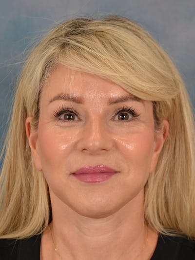 Brow Lift Before & After Gallery - Patient 208538 - Image 2
