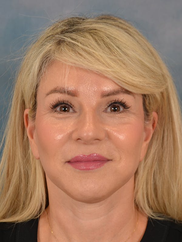 Brow Lift Before & After Gallery - Patient 208538 - Image 2