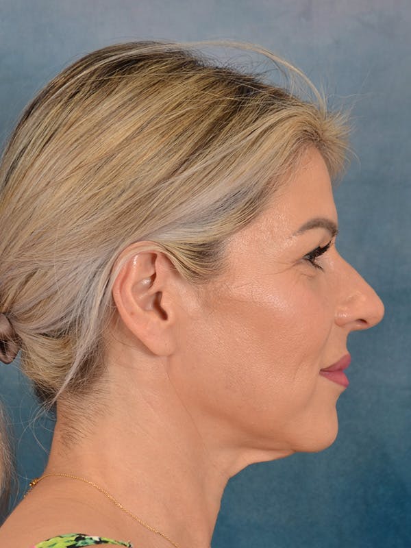 Brow Lift Before & After Gallery - Patient 208538 - Image 9