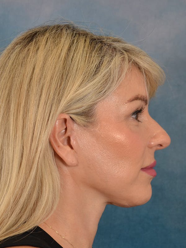 Brow Lift Before & After Gallery - Patient 208538 - Image 10