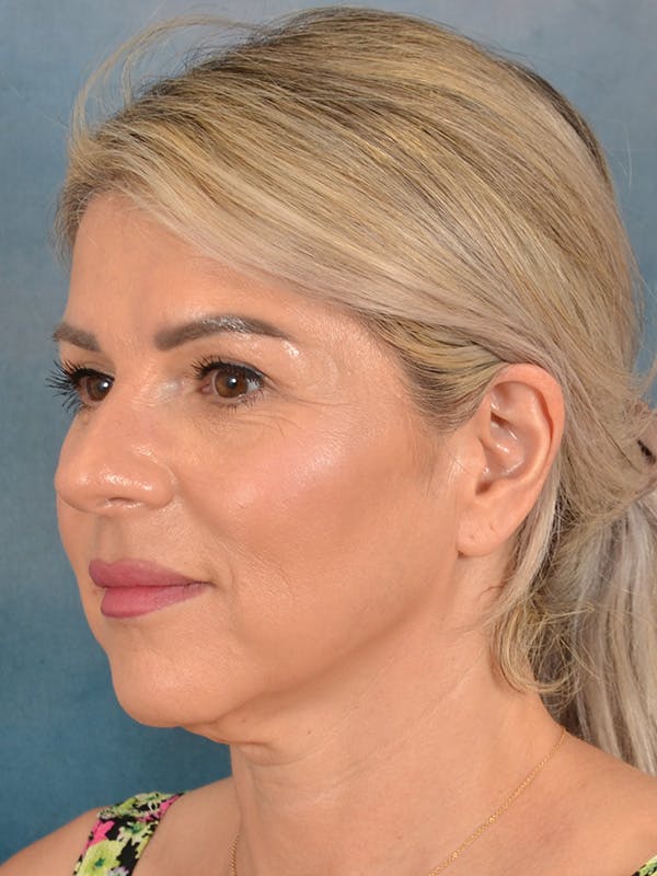 Brow Lift Before & After Gallery - Patient 208538 - Image 3