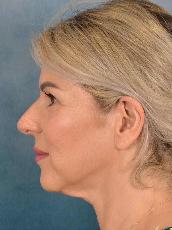 Brow Lift Before & After Gallery - Patient 208538 - Image 5