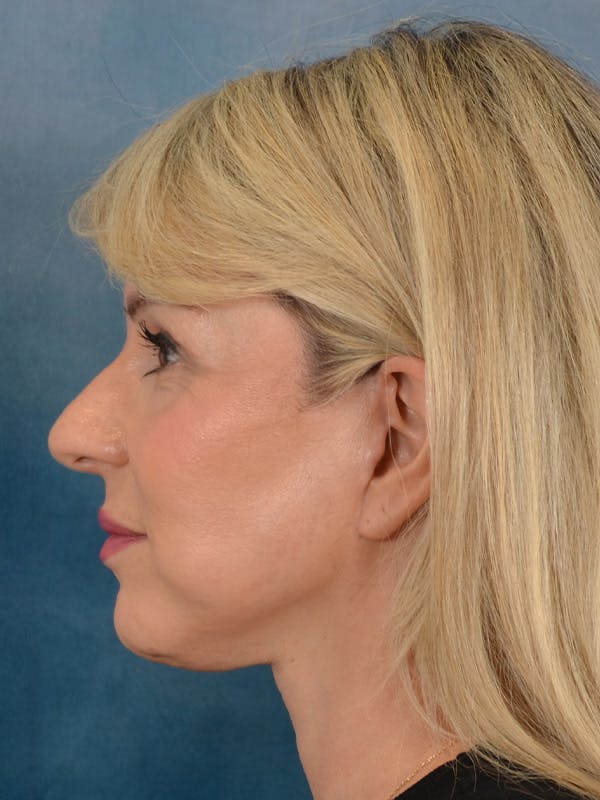 Brow Lift Before & After Gallery - Patient 208538 - Image 6