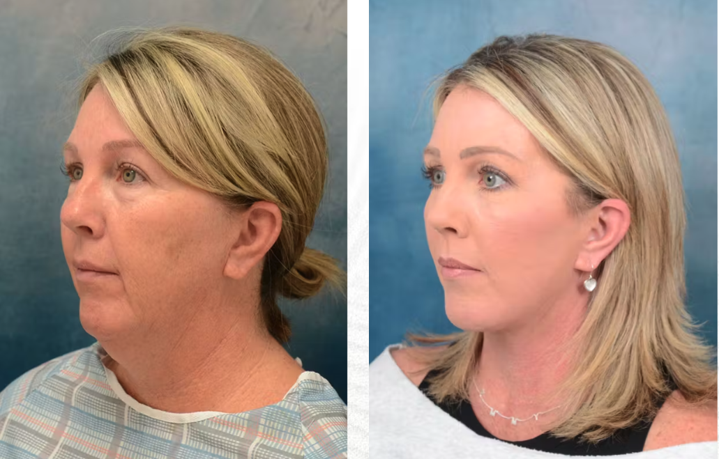 Facelift before & after