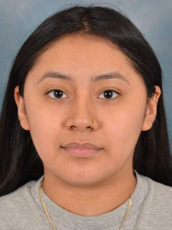 Rhinoplasty Before & After Gallery - Patient 544468 - Image 5