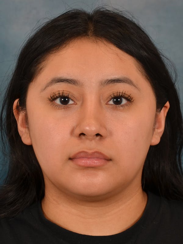 Rhinoplasty Before & After Gallery - Patient 544468 - Image 6