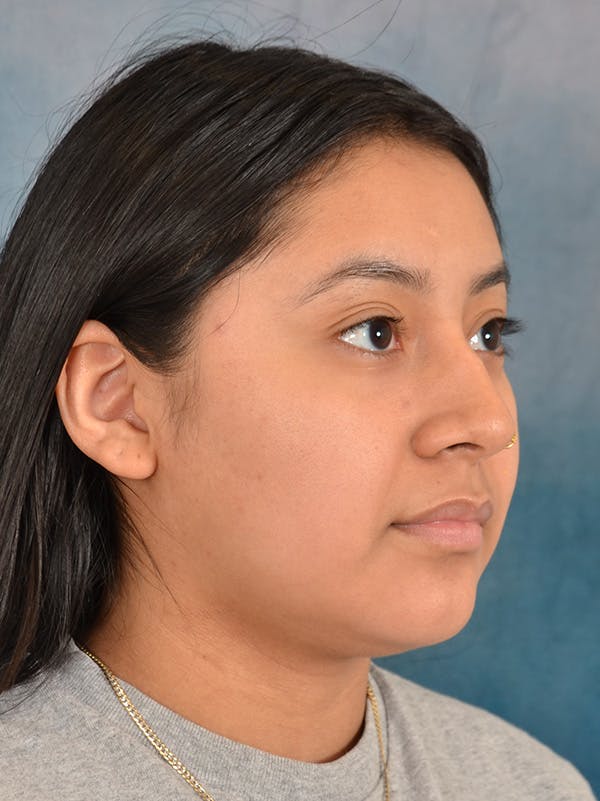 Rhinoplasty Before & After Gallery - Patient 544468 - Image 7