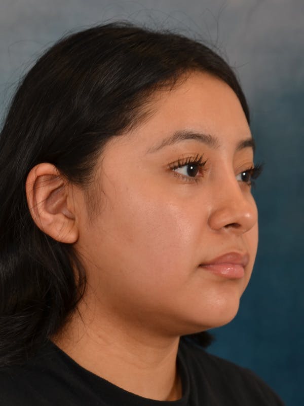 Rhinoplasty Before & After Gallery - Patient 544468 - Image 8
