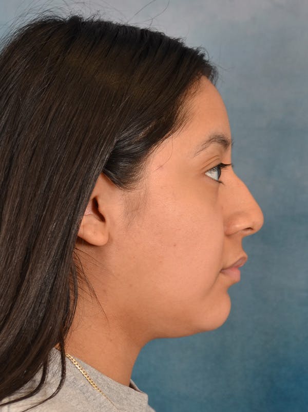 Rhinoplasty Before & After Gallery - Patient 544468 - Image 9