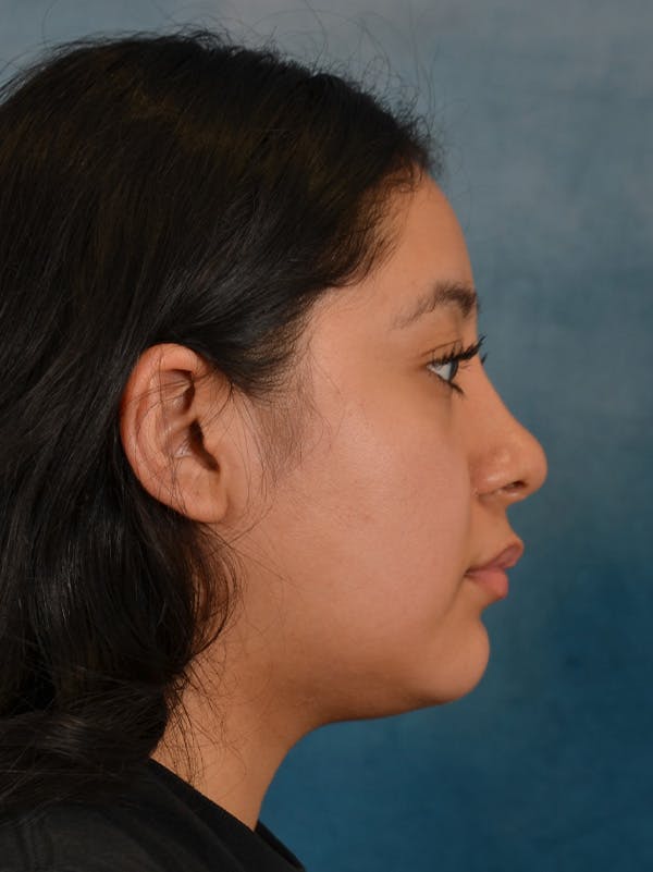 Rhinoplasty Before & After Gallery - Patient 544468 - Image 10