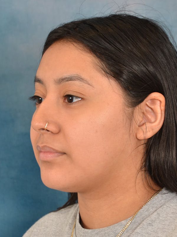 Rhinoplasty Before & After Gallery - Patient 544468 - Image 3