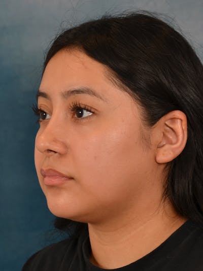 Rhinoplasty Before & After Gallery - Patient 544468 - Image 4