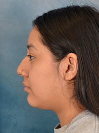 Rhinoplasty Before & After Gallery - Patient 544468 - Image 1