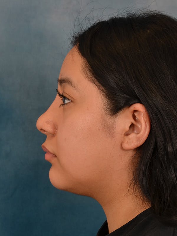 Rhinoplasty Before & After Gallery - Patient 544468 - Image 2