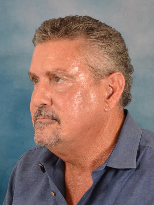 Deep Plane Facelift Before & After Gallery - Patient 113853 - Image 1