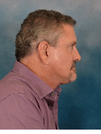 Deep Plane Facelift Before & After Gallery - Patient 113853 - Image 10