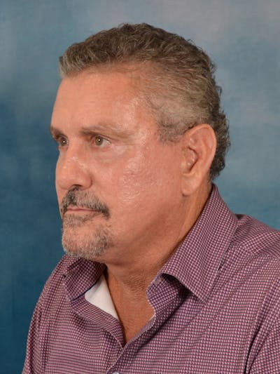 Deep Plane Facelift Before & After Gallery - Patient 113853 - Image 2