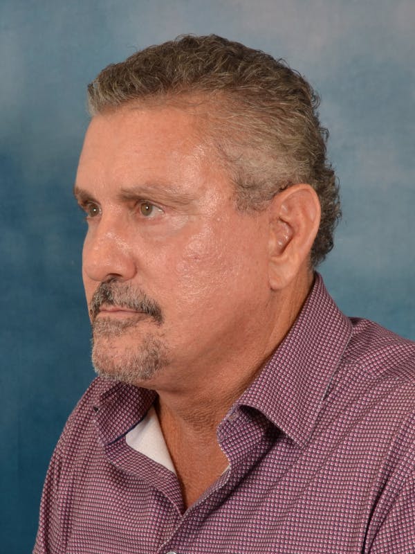 Deep Plane Facelift Before & After Gallery - Patient 113853 - Image 2