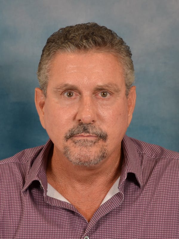 Deep Plane Facelift Before & After Gallery - Patient 113853 - Image 4