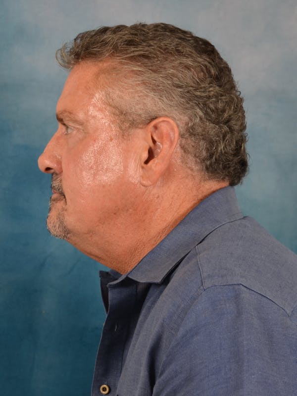 Deep Plane Facelift Before & After Gallery - Patient 113853 - Image 5
