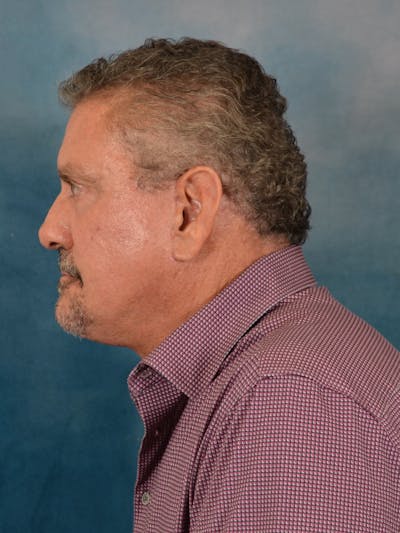 Deep Plane Facelift Before & After Gallery - Patient 113853 - Image 6