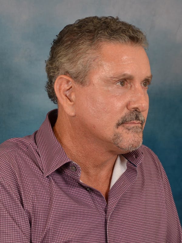 Deep Plane Facelift Before & After Gallery - Patient 113853 - Image 8