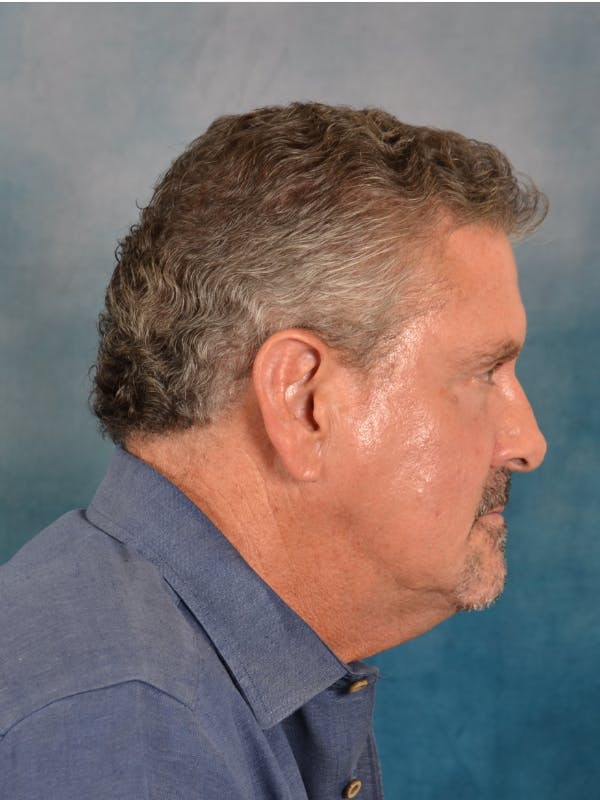 Deep Plane Facelift Before & After Gallery - Patient 113853 - Image 9