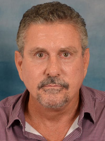 Laser Skin Resurfacing Before & After Gallery - Patient 207688 - Image 2