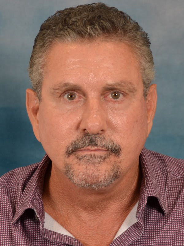 Laser Skin Resurfacing Before & After Gallery - Patient 207688 - Image 2