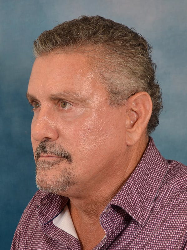 Laser Skin Resurfacing Before & After Gallery - Patient 207688 - Image 4