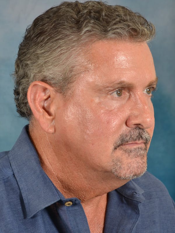Laser Skin Resurfacing Before & After Gallery - Patient 207688 - Image 7