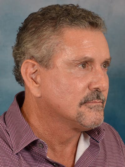 Laser Skin Resurfacing Before & After Gallery - Patient 207688 - Image 8