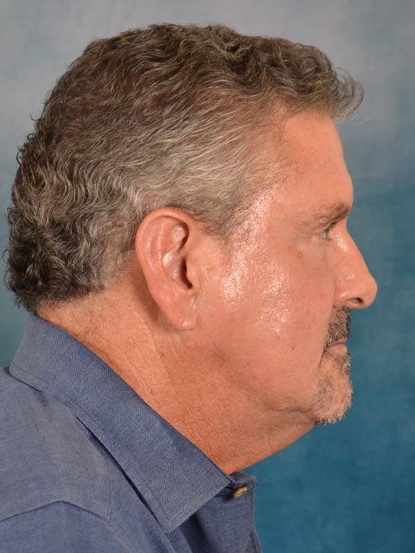 Laser Skin Resurfacing Before & After Gallery - Patient 207688 - Image 9