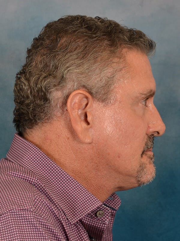 Laser Skin Resurfacing Before & After Gallery - Patient 207688 - Image 10