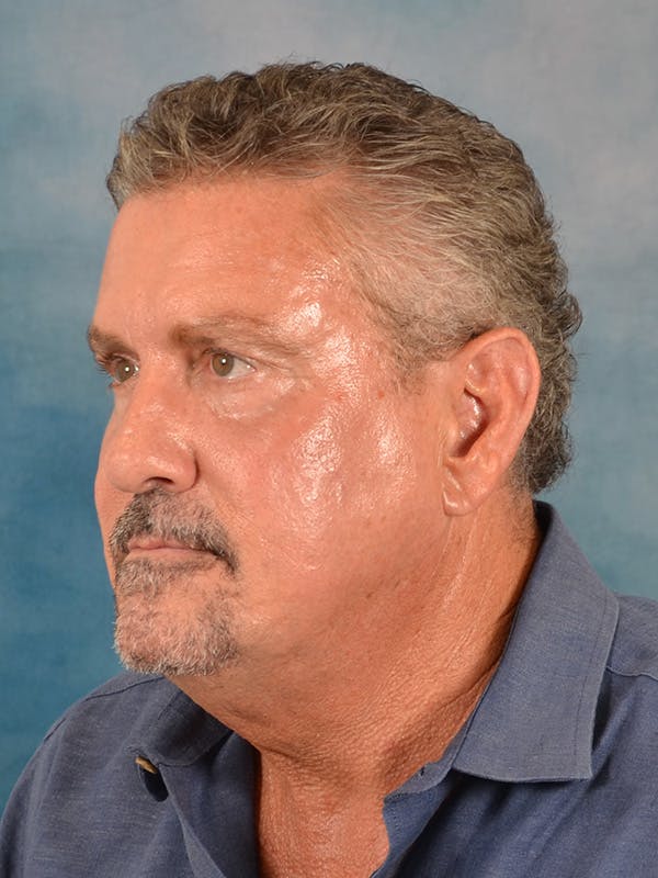 Laser Skin Resurfacing Before & After Gallery - Patient 207688 - Image 3