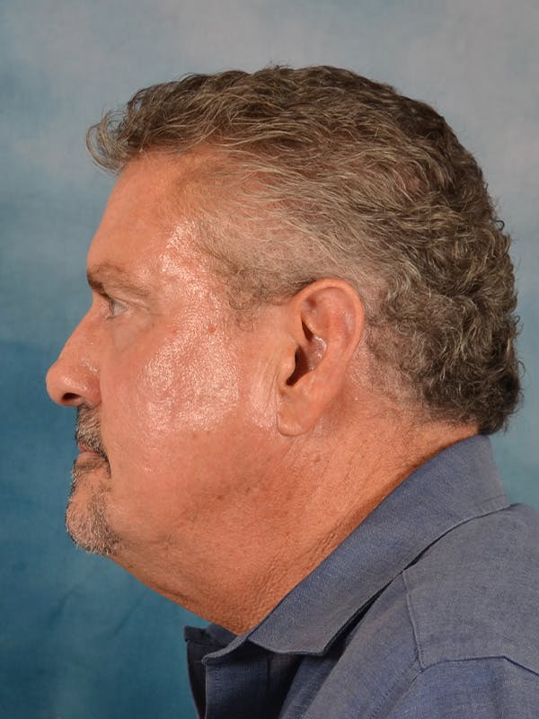 Laser Skin Resurfacing Before & After Gallery - Patient 207688 - Image 5