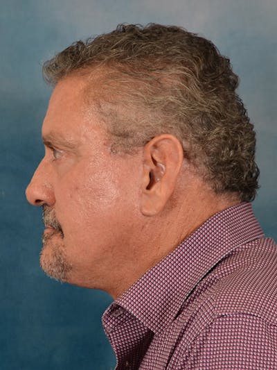 Laser Skin Resurfacing Before & After Gallery - Patient 207688 - Image 6