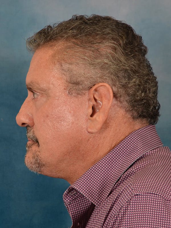 Deep Plane Facelift Before & After Gallery - Patient 148969 - Image 4