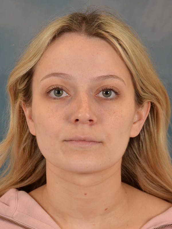 Rhinoplasty Before & After Gallery - Patient 365273 - Image 5